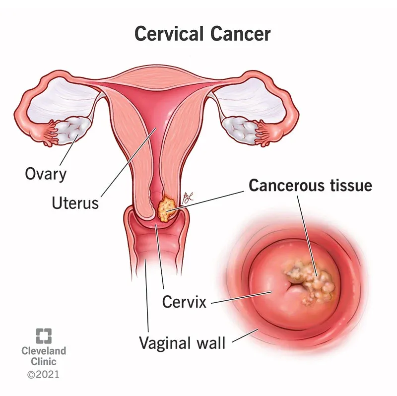 জরায়ুমুখ ক্যান্সার (Cervical Cancer)