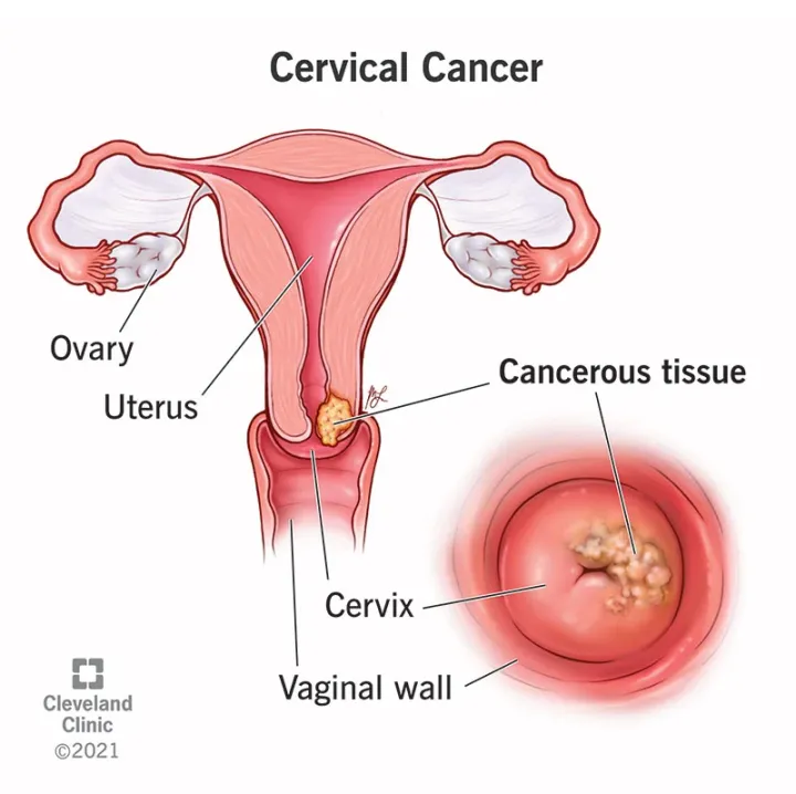 জরায়ুমুখ ক্যান্সার (Cervical Cancer)