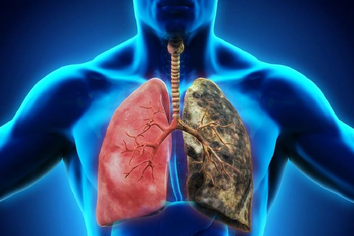 বিশ্ব ফুসফুস দিবস (ফুসফুস ক্যান্সার) (Lung Cancer)