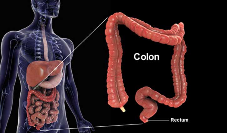 মলাশয়ের ক্যান্সার (Colorectal Cancer)